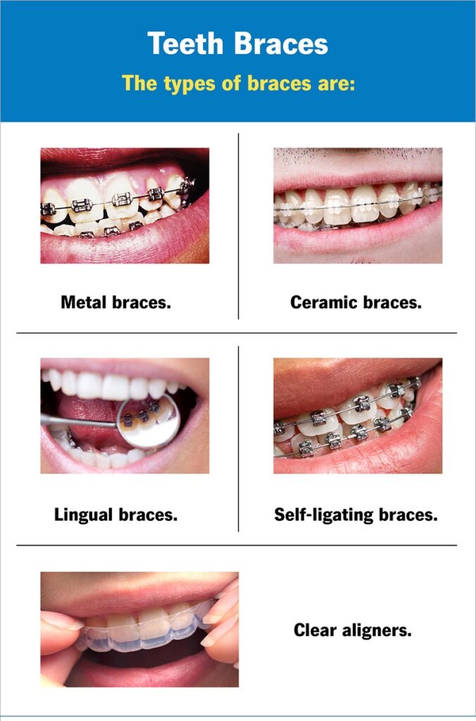 Type Of barces