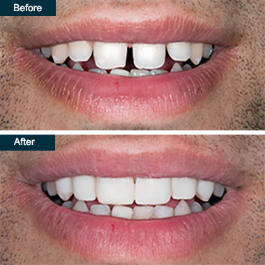 Cosmetic Dental Bonding