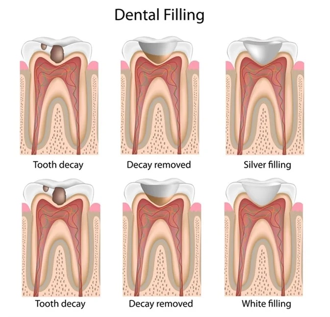 Dental Filling in Hisar