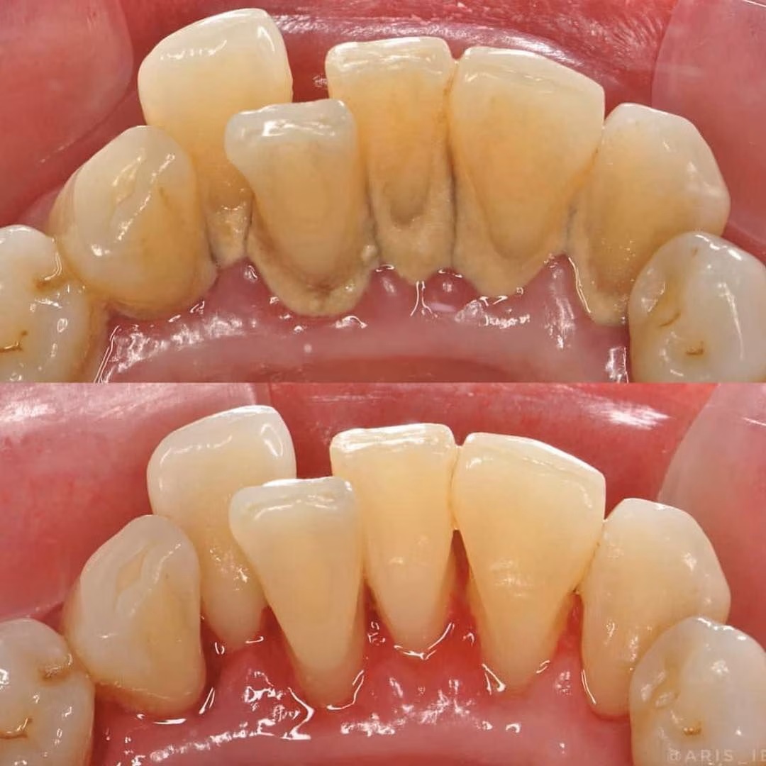 Teeth Scaling in Hisar