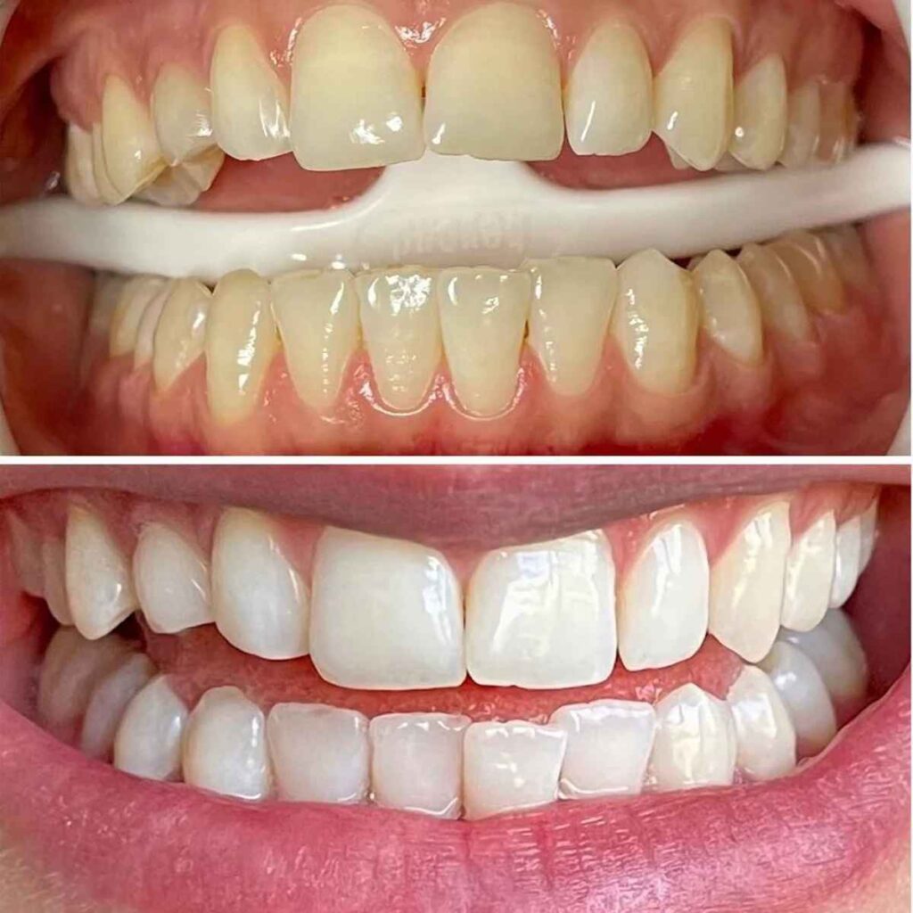 Teeth Whitening