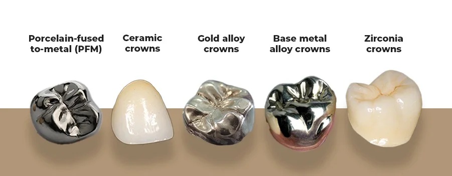 Types-of-dental-crowns in Hisar