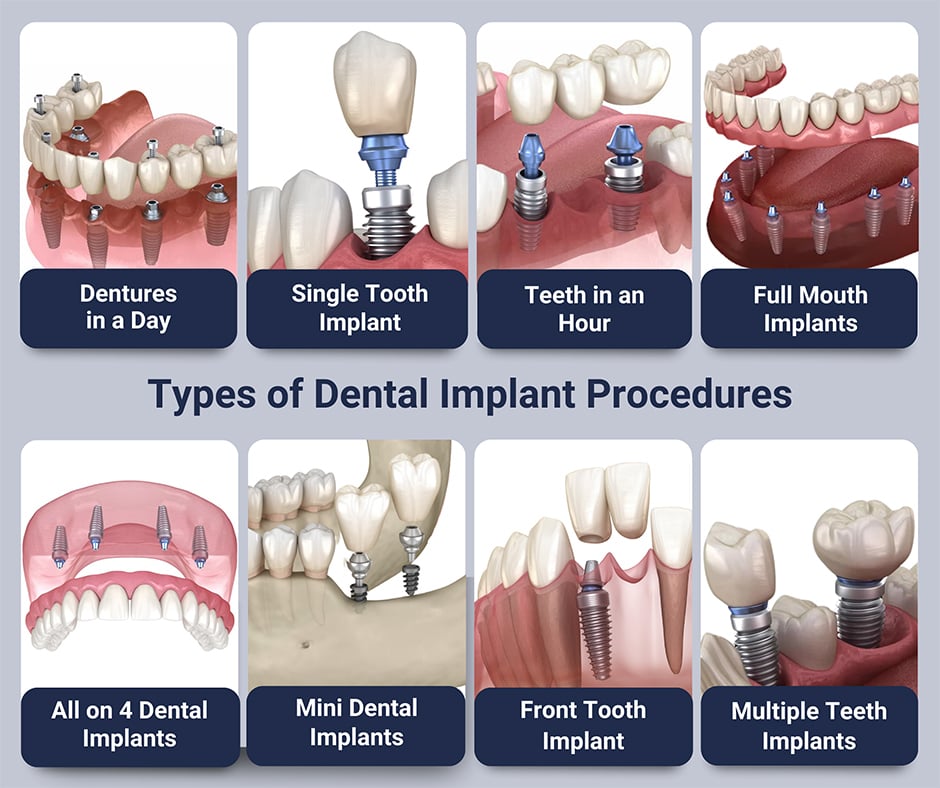 Type of Dental Implants