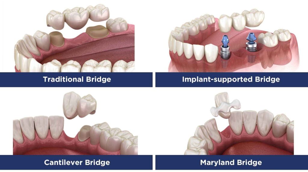 Types of Dental Bridges​