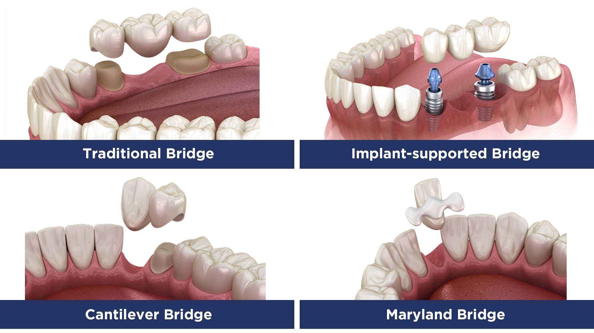 Types of Dental Bridges​