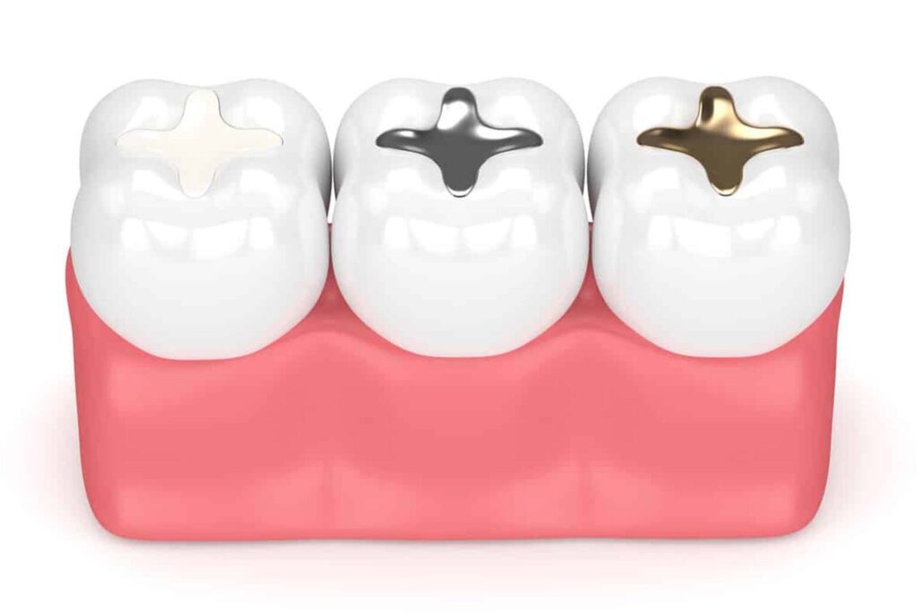 Tooth-Coloured Fillings