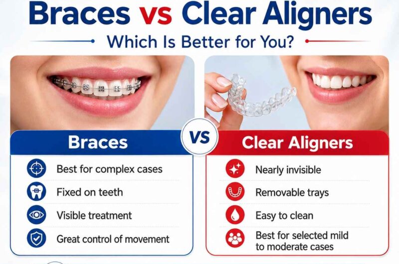Braces vs Clear Aligners: Which is Better for You?