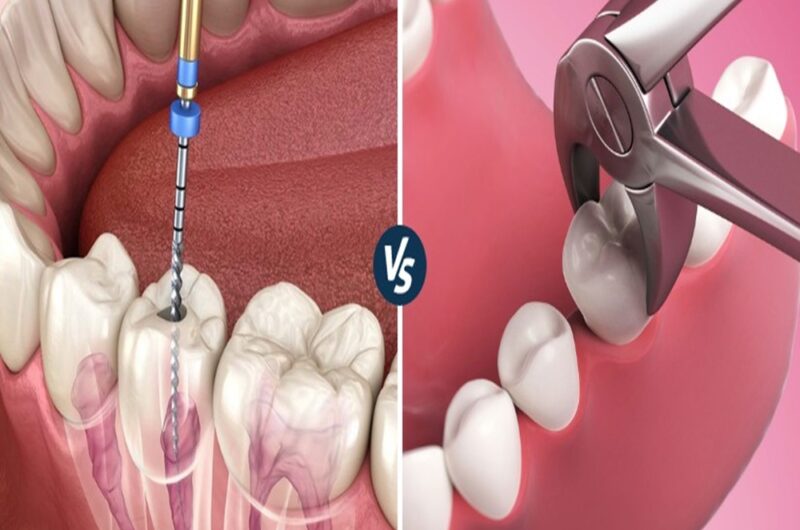Root Canal or Tooth Extraction: Which Option Can Save Your Tooth?