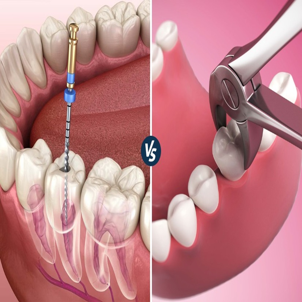 Root-Canal-vs-Extraction-Which-is-Right-for-you