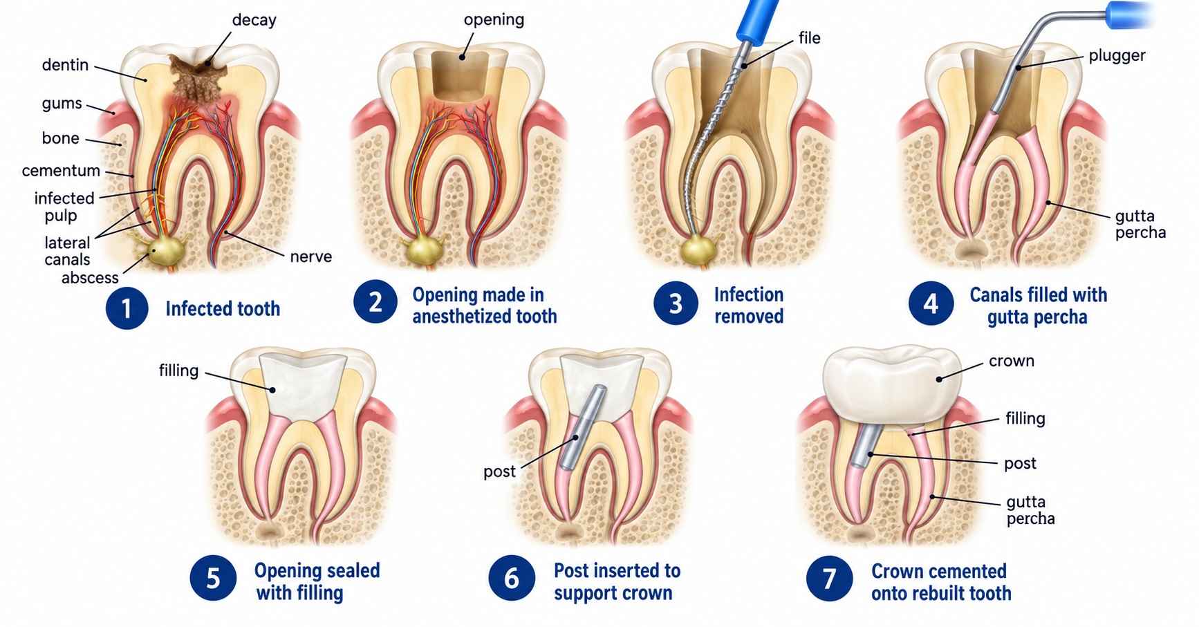 Root Canal Procedure