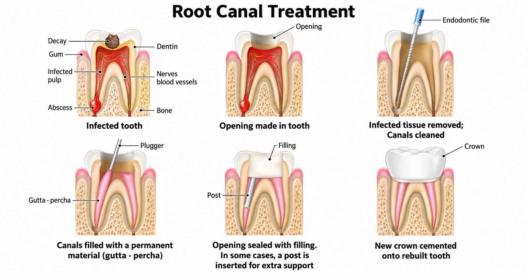 Root Canal Treatment