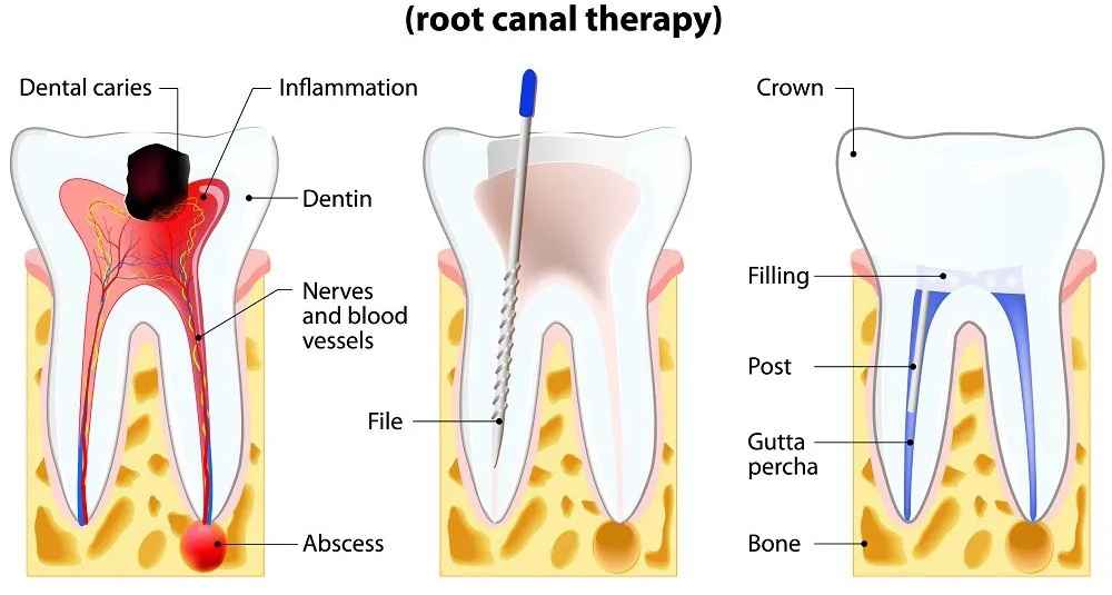 complete-smile-dental-root-canal-treatment