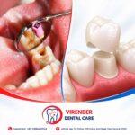 Dental Crown After Root Canal