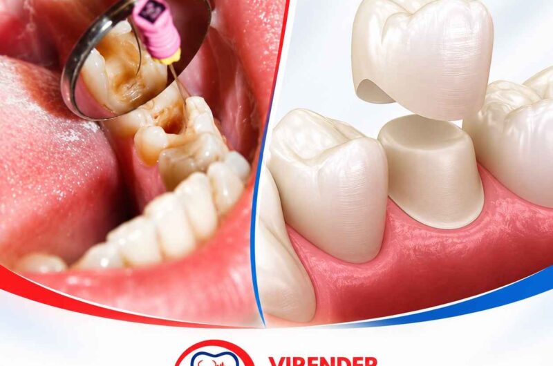 Dental Crown After Root Canal: Is It Really Necessary?