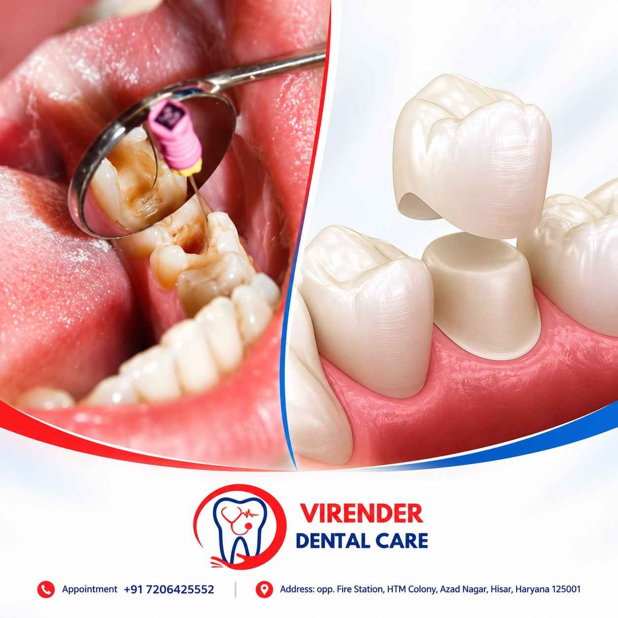 Dental Crown After Root Canal